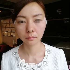 剛做完翊品鈴鐺線術后狀態(tài)不錯 剛做完翊品鈴鐺線術后狀態(tài)不錯