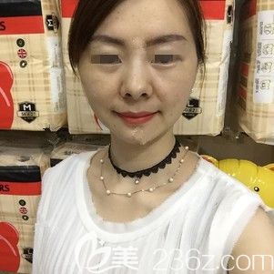 術后一周不再僵硬的翊品鈴鐺線效果 術后一周不再僵硬的翊品鈴鐺線效果