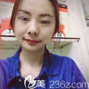 28歲就開始出現(xiàn)面部下垂鼻唇溝明顯到徐州時(shí)光洪揚(yáng)做了線雕抗衰中的佼佼者——翊品線，分享術(shù)后蛻變