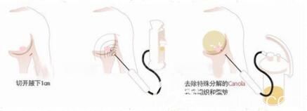 切開法去副乳和抽脂法去副乳區(qū)別