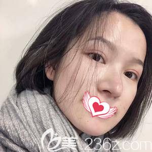 在張家口維多利亞注射玻尿酸前是大長臉 在張家口維多利亞注射玻尿酸前是大長臉