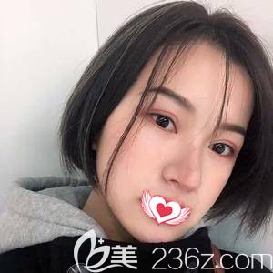 王亞勇醫(yī)生為我注射玻尿酸填充面部術(shù)后3天面部微腫 王亞勇醫(yī)生為我注射玻尿酸填充面部術(shù)后3天面部微腫