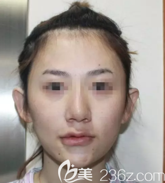 面部自體脂肪膠填充術(shù)前照片 面部自體脂肪膠填充術(shù)前照片