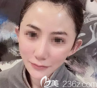 面部自體脂肪膠術(shù)后一個月 面部自體脂肪膠術(shù)后一個月