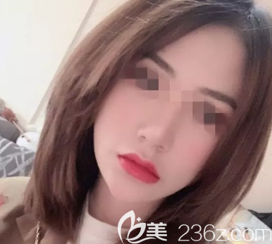 濟南寶琳娜做自體脂肪填充挺好的，并且收費價格合理（附照片）