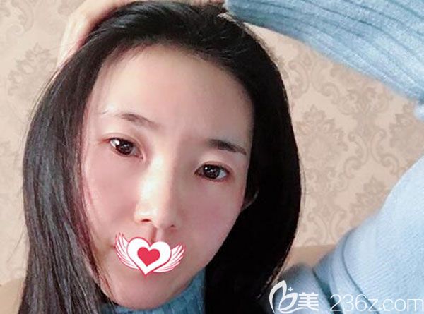 自體脂肪豐淚溝20天沒有出現(xiàn)兩道愣 自體脂肪豐淚溝20天沒有出現(xiàn)兩道愣