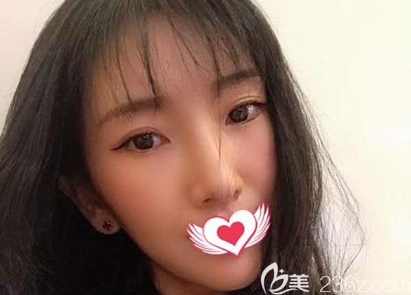 找美萊做了自體脂肪填充淚溝，一年后脂肪仍然很穩(wěn)定，看來口碑好的醫(yī)院就是不一樣