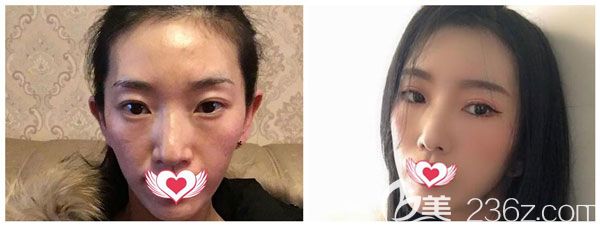 自體脂肪填充淚溝一個月的對比照片 自體脂肪填充淚溝一個月的對比照片