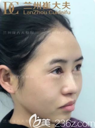 崔大夫整形小切口雙眼+開眼角第1天 崔大夫整形小切口雙眼+開眼角第1天