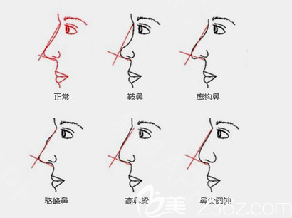 各種鼻部問題示意圖