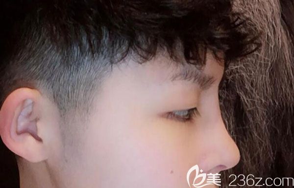 硅膠隆鼻第7天鼻子的高度是我喜歡的