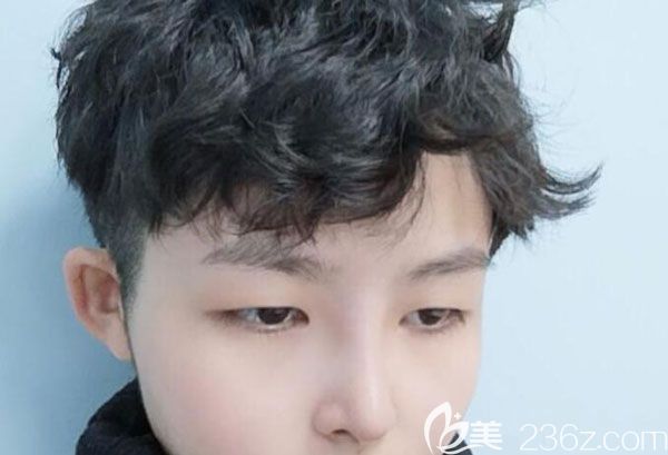 硅膠假體隆鼻第17天鼻尖精致圓潤