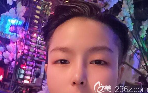 硅膠隆鼻30天鼻子基本已經(jīng)定型