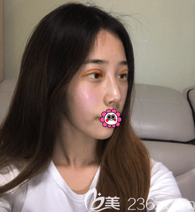 醫(yī)生給我做美眸成形術(shù)第3天