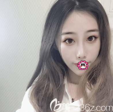 在北京新星靚做美眸成形術(shù)一個半月樣子