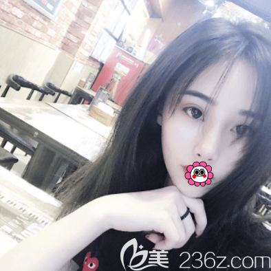 北京新星靚雙眼皮案例效果我挺喜歡不過(guò)我做了芭比美眸成形術(shù)