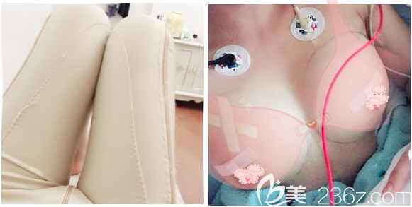 自體脂肪脂肪豐胸和大腿吸脂術(shù)后即刻效果圖 自體脂肪脂肪豐胸和大腿吸脂術(shù)后即刻效果圖