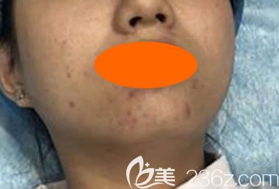 沒去<!--<i data=20240703-sp></i>-->美容醫(yī)院做微針祛痘前照片 沒去<!--<i data=20240703-sp></i>-->美容醫(yī)院做微針祛痘前照片