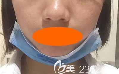 我去<!--<i data=20240703-sp></i>-->美容醫(yī)院找周玲做微針祛痘+縮小毛孔術(shù)后第6天 我去<!--<i data=20240703-sp></i>-->美容醫(yī)院找周玲做微針祛痘+縮小毛孔術(shù)后第6天