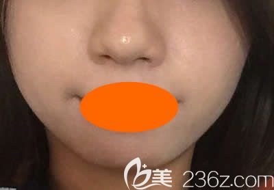 我去<!--<i data=20240703-sp></i>-->美容醫(yī)院找周玲做微針祛痘術(shù)后第25天效果 我去<!--<i data=20240703-sp></i>-->美容醫(yī)院找周玲做微針祛痘術(shù)后第25天效果