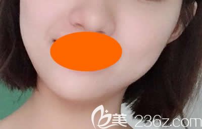 美容醫(yī)院周玲整形案例：微整祛痘+縮小毛孔術(shù)后40天恢復(fù)過程及效果展示