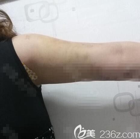 吸脂術(shù)后7天 吸脂術(shù)后7天