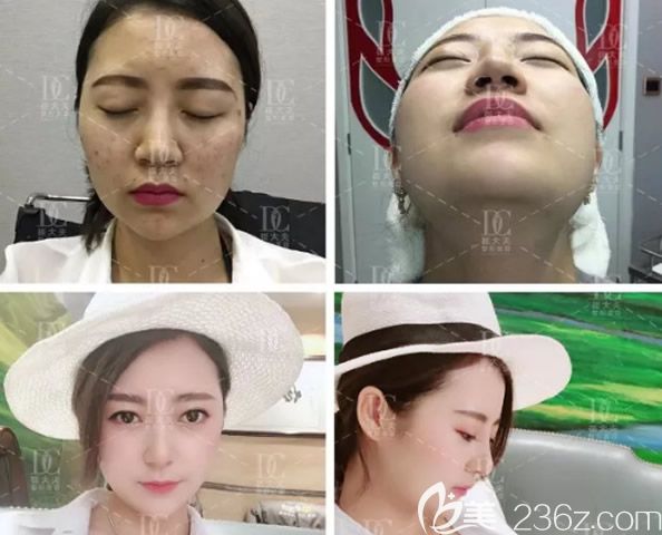 蘭州崔大夫徐隴豫自體肋軟骨隆鼻+小切口雙眼皮手術(shù)前后對(duì)比照片