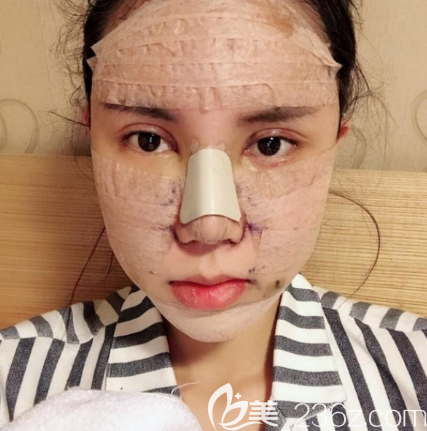 韓國(guó)愛(ài)我整形醫(yī)院鼻綜合隆鼻+自體脂肪豐面術(shù)后效果