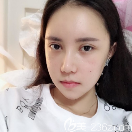 韓國(guó)愛(ài)我整形假體隆鼻+全臉填充真實(shí)恢復(fù)效果圖