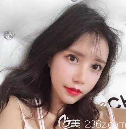 韓國(guó)愛(ài)我鼻綜合+自體脂肪面部填充術(shù)后1個(gè)半月恢復(fù)圖