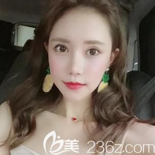 ?韓國愛我整形醫(yī)院做鼻綜合隆鼻時(shí)院長建議自體脂肪填充全臉,果然美出新高度