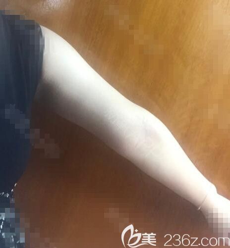 韓國勞波兒吸脂真人案例 韓國勞波兒吸脂真人案例