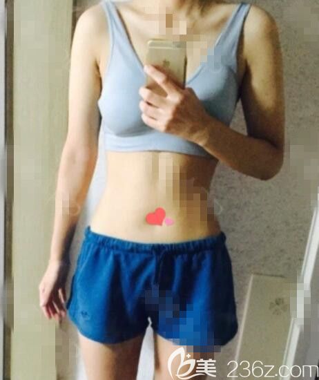 韓國ROVL勞波兒吸脂怎么樣 韓國ROVL勞波兒吸脂怎么樣