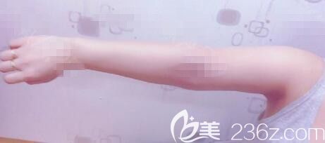 韓國ROVL勞波兒手臂吸脂案例 韓國ROVL勞波兒手臂吸脂案例