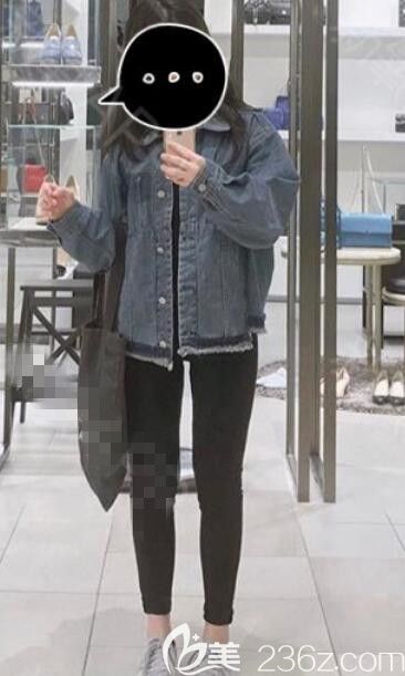 記錄我在韓國ROVL勞波兒醫(yī)院做的大腿吸脂、手臂吸脂7個月