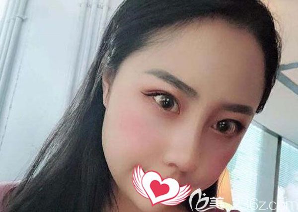 肋軟骨鼻修復(fù)30天鼻子已經(jīng)定型 肋軟骨鼻修復(fù)30天鼻子已經(jīng)定型