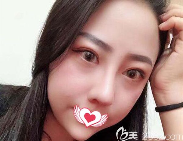 隆鼻失敗二次修復(fù)60天鼻梁鼻尖都很立體 隆鼻失敗二次修復(fù)60天鼻梁鼻尖都很立體