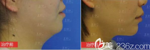 蘭州崔大夫整形面部打溶脂針一周的效果圖