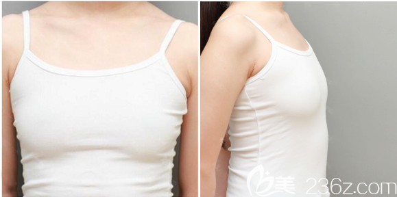 在廣州天姿做隆胸手術(shù)前的樣子 在廣州天姿做隆胸手術(shù)前的樣子