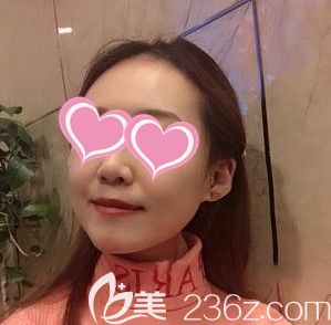 給大家看看長春中研整形玻尿酸填充法令紋和瘦臉去咬肌的效果怎么樣