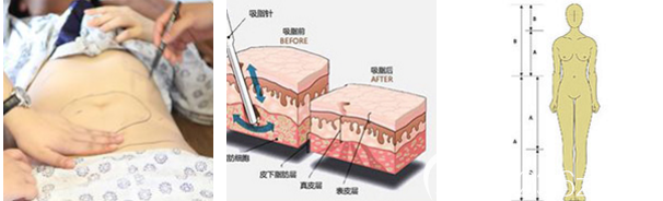 廣州美萊鄧勁松吸脂手術(shù)過程圖 廣州美萊鄧勁松吸脂手術(shù)過程圖