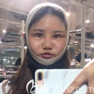 韓國綺林面部輪廓整形術(shù)后1周恢復效果 韓國綺林面部輪廓整形術(shù)后1周恢復效果
