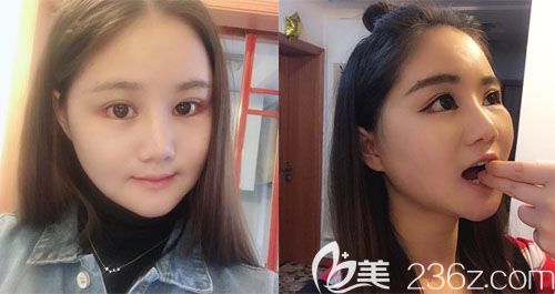 做面部輪廓術(shù)后15天真實效果圖 做面部輪廓術(shù)后15天真實效果圖