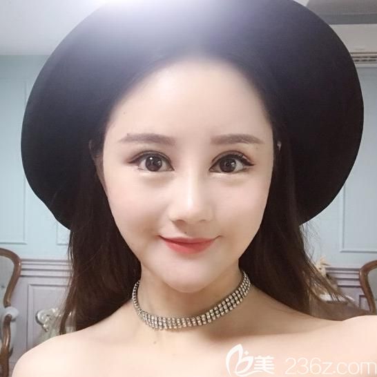 韓國面部輪廓整形案例術(shù)后半年恢復照片 韓國面部輪廓整形案例術(shù)后半年恢復照片