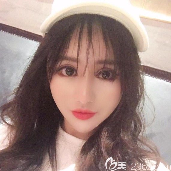 韓國綺林整形醫(yī)院面部輪廓術(shù)價(jià)格優(yōu)惠,做了顴骨顴弓+去下頜角+Vline下巴整形恢復(fù)圖