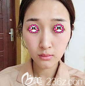 在北京藝星做硅膠假體隆鼻前樣子 在北京藝星做硅膠假體隆鼻前樣子