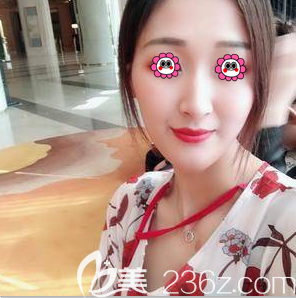 在北京藝星做硅膠假體隆鼻第36天效果 在北京藝星做硅膠假體隆鼻第36天效果