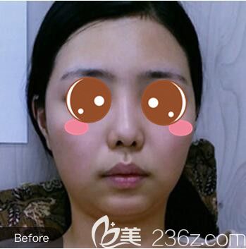 <!--<i data=20240703-sp></i>-->仁愛醫(yī)院整形美容科郭新雯面部吸脂+隆鼻真人案例術(shù)前照 <!--<i data=20240703-sp></i>-->仁愛醫(yī)院整形美容科郭新雯面部吸脂+隆鼻真人案例術(shù)前照