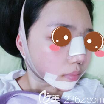 <!--<i data=20240703-sp></i>-->仁愛醫(yī)院整形美容科郭新雯面部吸脂+隆鼻真人案例術(shù)后第三天 <!--<i data=20240703-sp></i>-->仁愛醫(yī)院整形美容科郭新雯面部吸脂+隆鼻真人案例術(shù)后第三天