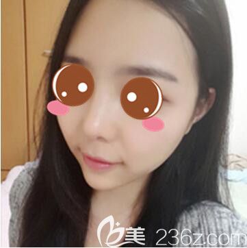 <!--<i data=20240703-sp></i>-->仁愛醫(yī)院整形美容科郭新雯面部吸脂+隆鼻真人案例術(shù)后十五天 <!--<i data=20240703-sp></i>-->仁愛醫(yī)院整形美容科郭新雯面部吸脂+隆鼻真人案例術(shù)后十五天